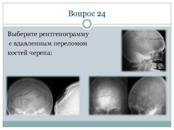 Вопрос 24 Выберите рентгенограмму с вдавленным переломом костей черепа: 