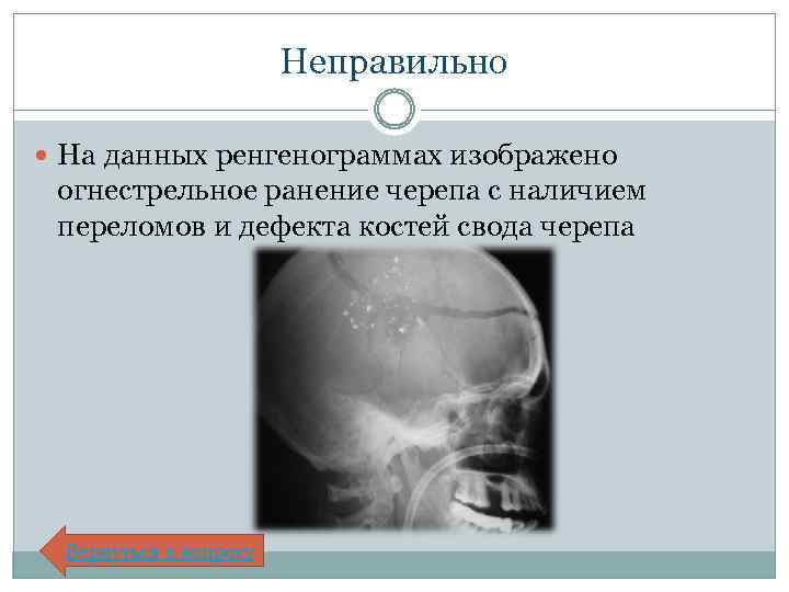 Неправильно На данных ренгенограммах изображено огнестрельное ранение черепа с наличием переломов и дефекта костей