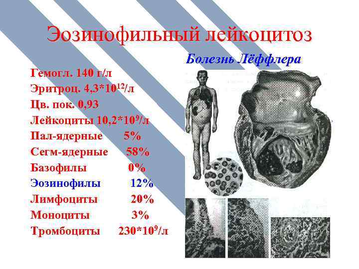 Эозинофильный лейкоцитоз Гемогл. 140 г/л Эритроц. 4, 3*1012/л Цв. пок. 0, 93 Лейкоциты 10,