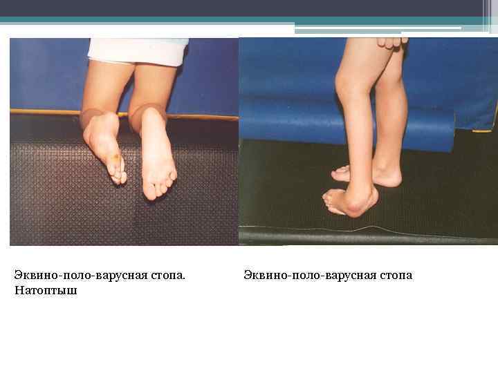 Эквино-поло-варусная стопа. Натоптыш Эквино-поло-варусная стопа 