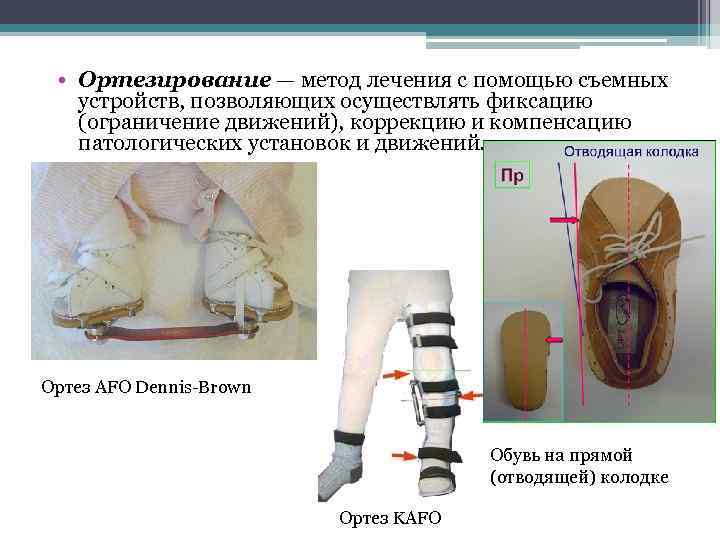  • Ортезирование — метод лечения с помощью съемных устройств, позволяющих осуществлять фиксацию (ограничение