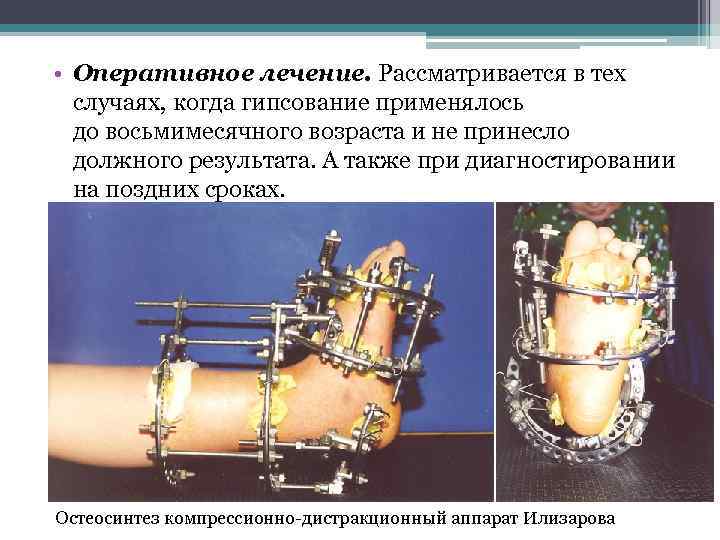  • Оперативное лечение. Рассматривается в тех случаях, когда гипсование применялось до восьмимесячного возраста