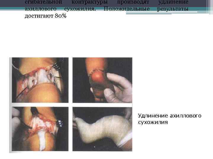 сгибательной контрактуры производят ахиллового сухожилия. Положительные достигают 80% удлинение результаты Удлинение ахиллового сухожилия 