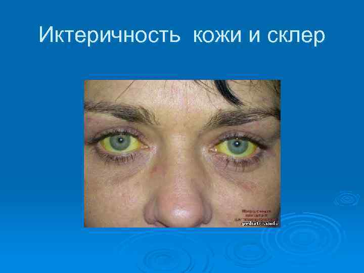 Иктеричность кожи и склер 