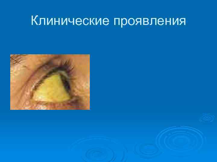Клинические проявления 