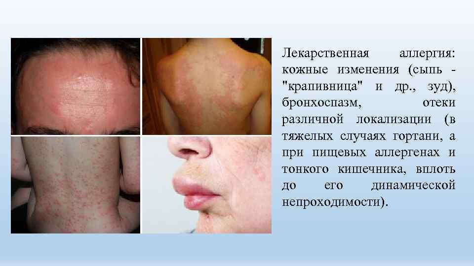 Лекарственная аллергия: кожные изменения (сыпь - 