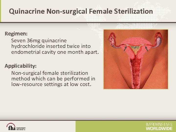 Quinacrine Non-surgical Female Sterilization Regimen: Seven 36 mg quinacrine hydrochloride inserted twice into endometrial