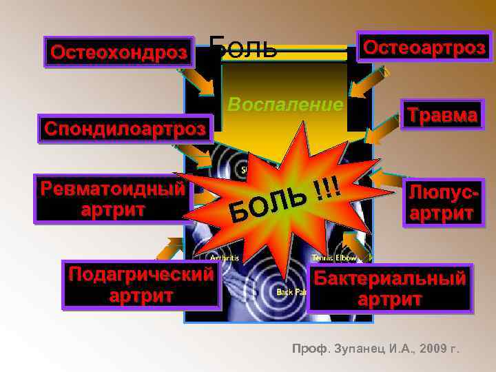 Остеохондроз Боль Остеоартроз В о с п а л е ни е Спондилоартроз Ревматоидный