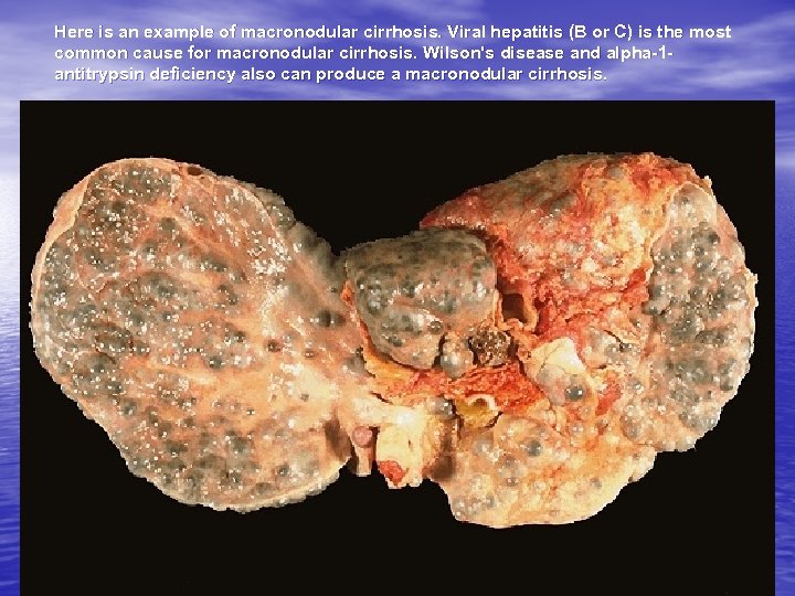 Here is an example of macronodular cirrhosis. Viral hepatitis (B or C) is the