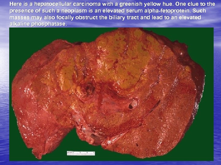 Here is a hepatocellular carcinoma with a greenish yellow hue. One clue to the