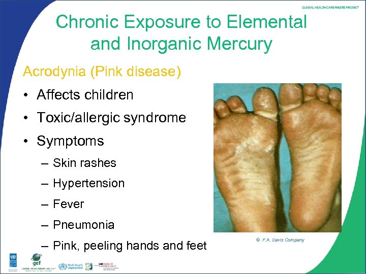 Chronic Exposure to Elemental and Inorganic Mercury Acrodynia (Pink disease) • Affects children •