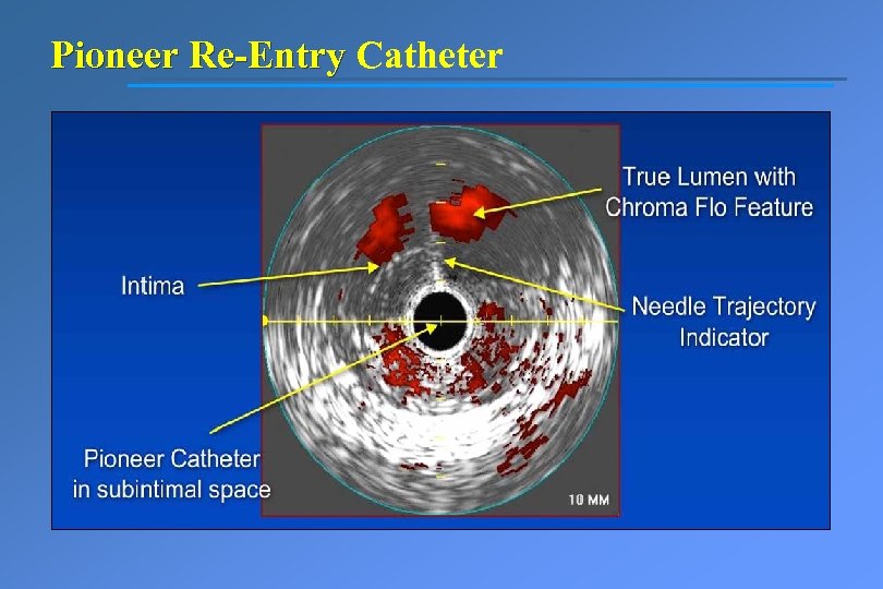 Pioneer Re-Entry Catheter 