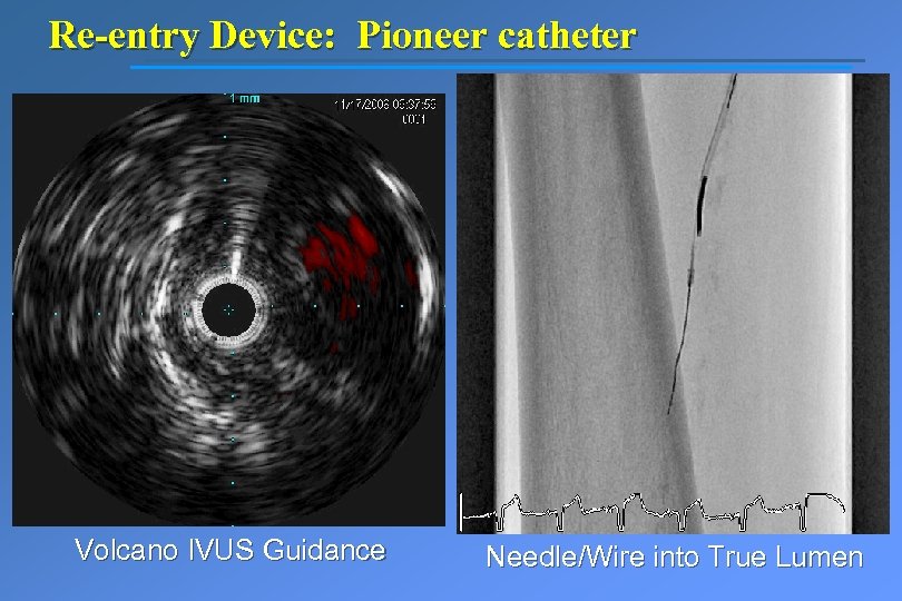 Re-entry Device: Pioneer catheter Volcano IVUS Guidance Needle/Wire into True Lumen 