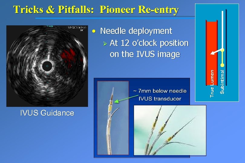 Tricks & Pitfalls: Pioneer Re-entry IVUS Guidance Subintimal True Lumen • Needle deployment Ø