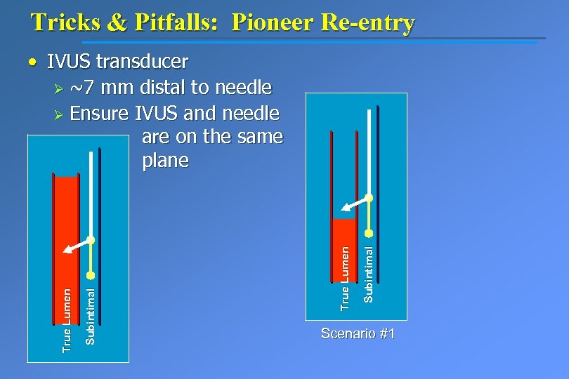 Tricks & Pitfalls: Pioneer Re-entry Subintimal True Lumen • IVUS transducer Ø ~7 mm