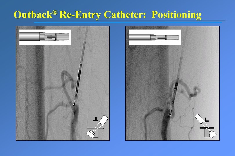 Outback® Re-Entry Catheter: Positioning 