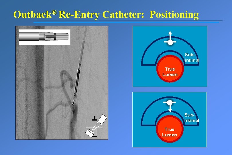 Outback® Re-Entry Catheter: Positioning Subintimal True Lumen 