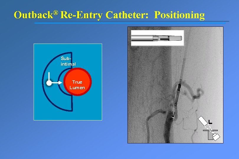 Outback® Re-Entry Catheter: Positioning Subintimal True Lumen 