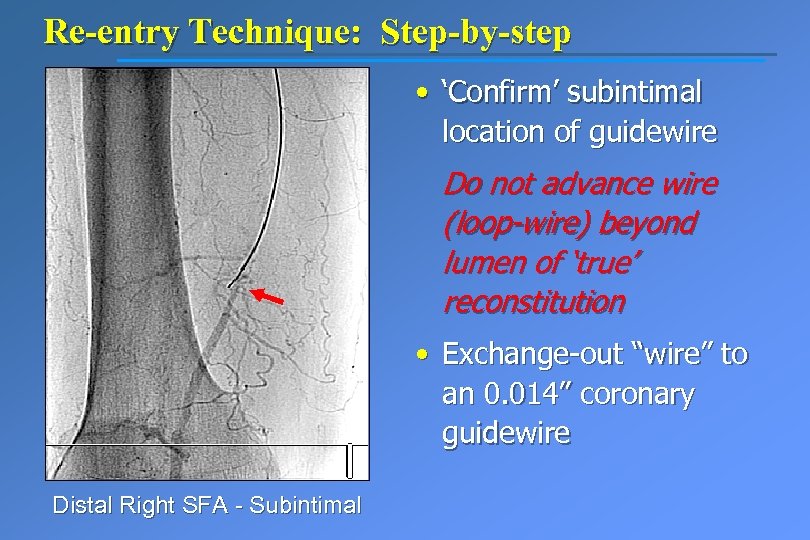 Re-entry Technique: Step-by-step • ‘Confirm’ subintimal location of guidewire Do not advance wire (loop-wire)