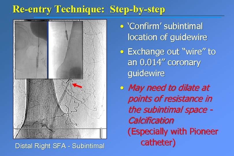 Re-entry Technique: Step-by-step • ‘Confirm’ subintimal location of guidewire • Exchange out “wire” to