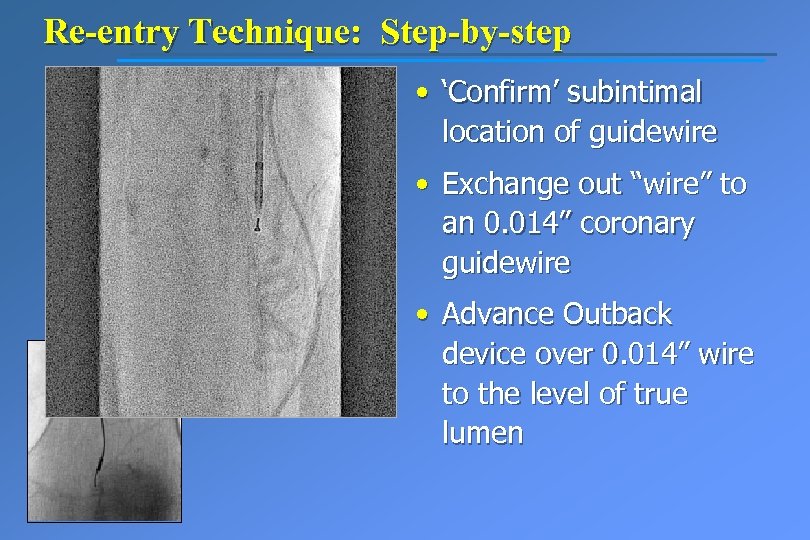 Re-entry Technique: Step-by-step • ‘Confirm’ subintimal location of guidewire • Exchange out “wire” to