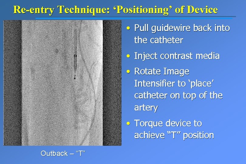 Re-entry Technique: ‘Positioning’ of Device • Pull guidewire back into the catheter • Inject