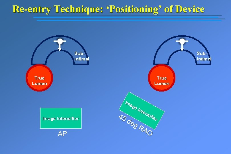 Re-entry Technique: ‘Positioning’ of Device Subintimal True Lumen Image Intensifier AP Im ag e.