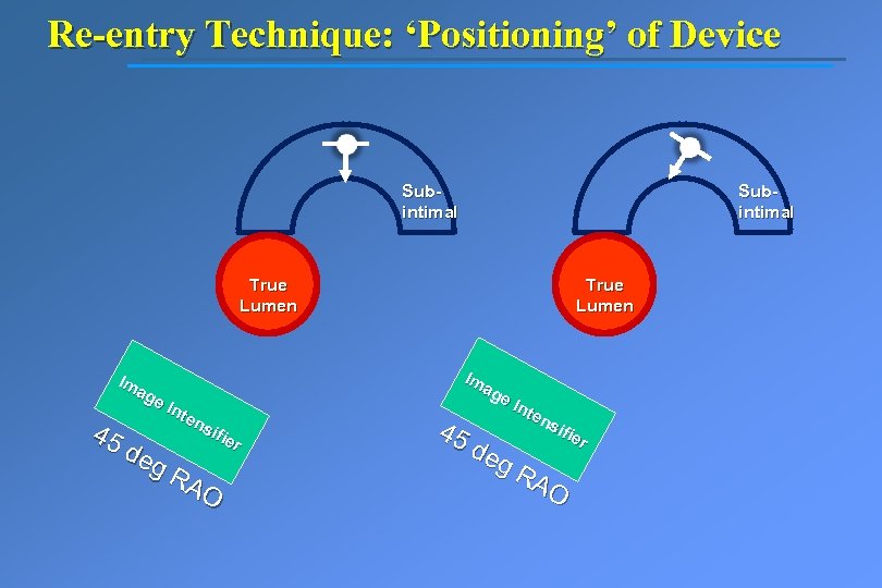 Re-entry Technique: ‘Positioning’ of Device Subintimal True Lumen Im ag e. I nte ns