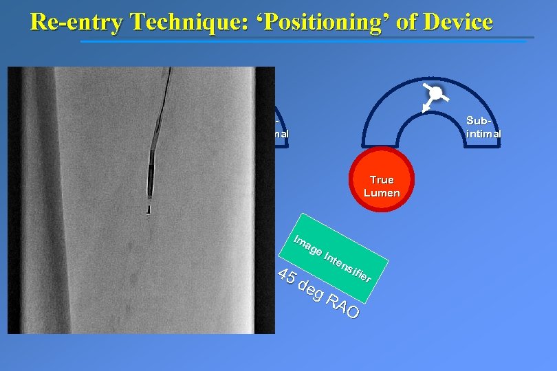 Re-entry Technique: ‘Positioning’ of Device Subintimal True Lumen Im ag e. I nte ns