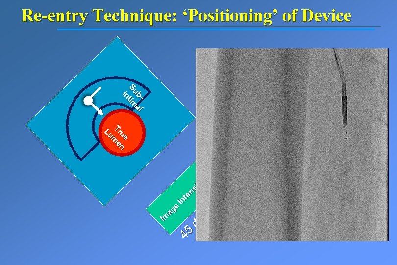 Re-entry Technique: ‘Positioning’ of Device b- all b Su ttiim Su m iin e