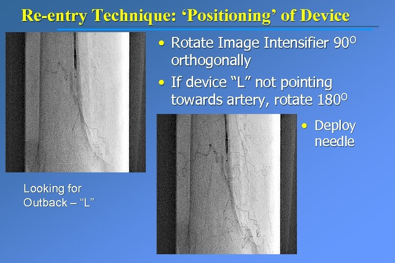 Re-entry Technique: ‘Positioning’ of Device • Rotate Image Intensifier 90 O orthogonally • If