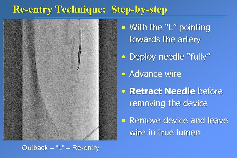 Re-entry Technique: Step-by-step • With the “L” pointing towards the artery • Deploy needle