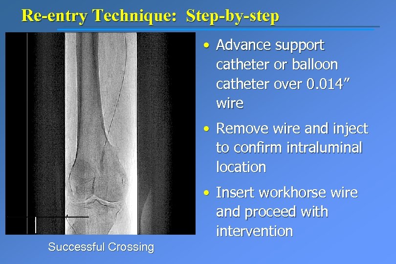 Re-entry Technique: Step-by-step • Advance support catheter or balloon catheter over 0. 014” wire