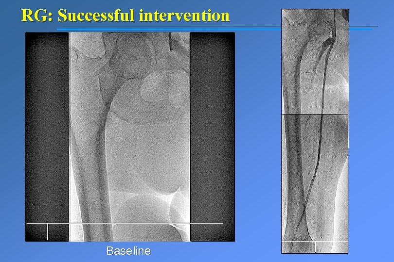 RG: Successful intervention Baseline 