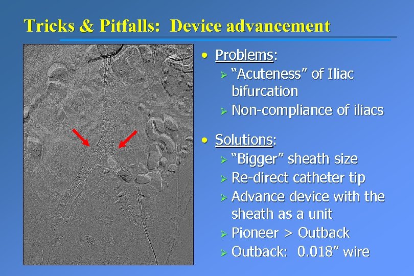 Tricks & Pitfalls: Device advancement • Problems: Ø “Acuteness” of Iliac bifurcation Ø Non-compliance