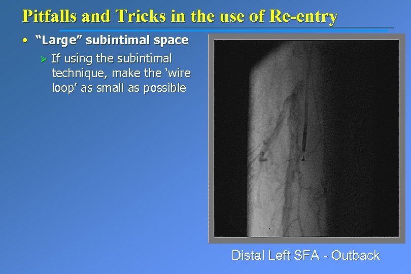 Pitfalls and Tricks in the use of Re-entry • “Large” subintimal space Ø If