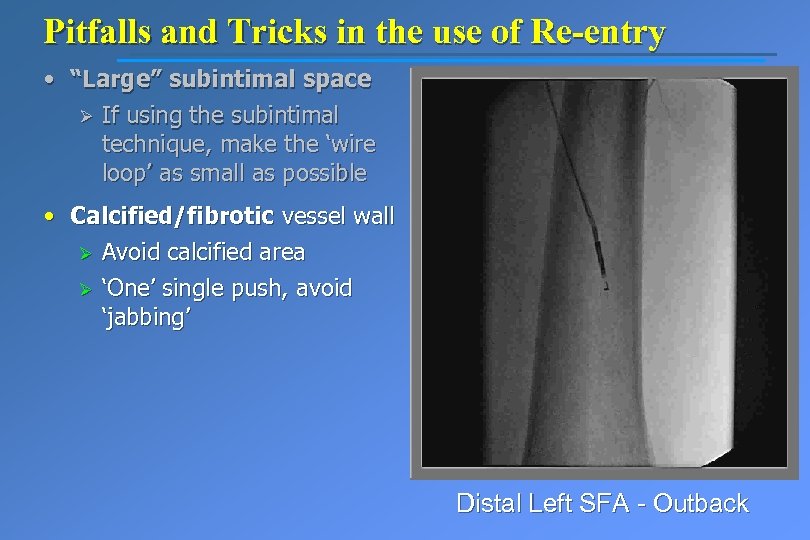 Pitfalls and Tricks in the use of Re-entry • “Large” subintimal space Ø If