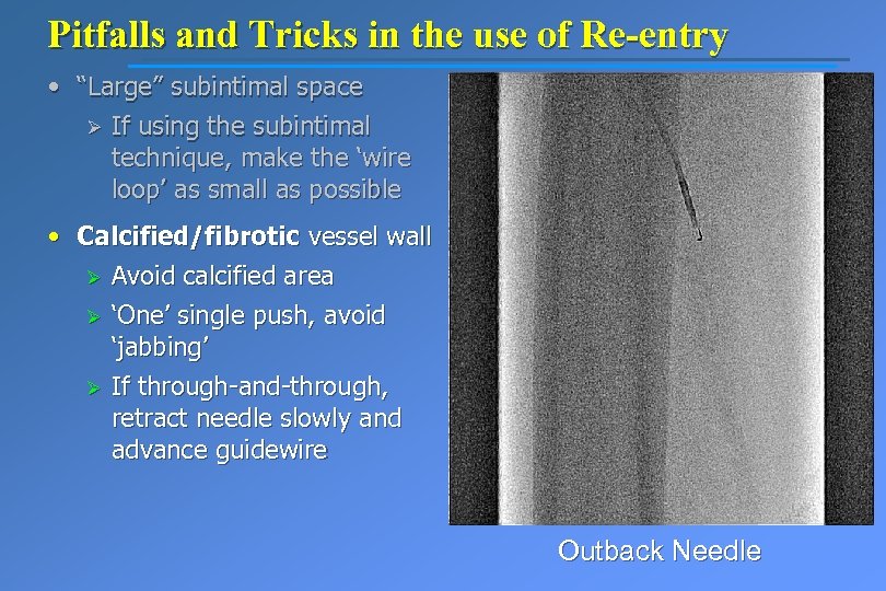 Pitfalls and Tricks in the use of Re-entry • “Large” subintimal space Ø If