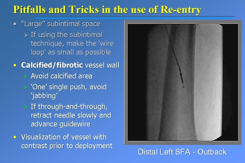 Pitfalls and Tricks in the use of Re-entry • “Large” subintimal space Ø If