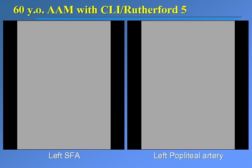 60 y. o. AAM with CLI/Rutherford 5 Left SFA Left Popliteal artery 