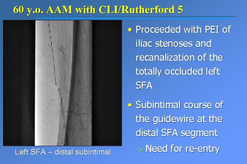 60 y. o. AAM with CLI/Rutherford 5 • Proceeded with PEI of iliac stenoses