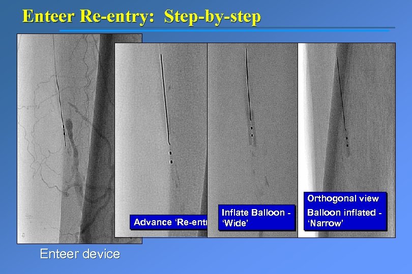 Enteer Re-entry: Step-by-step Inflate Balloon Advance ‘Re-entry Wire ‘Wide’ Enteer device Orthogonal view Balloon