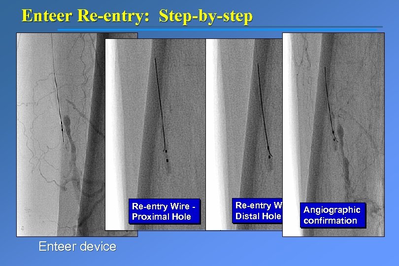 Enteer Re-entry: Step-by-step Re-entry Wire Proximal Hole Enteer device Re-entry Wire Angiographic Distal Hole