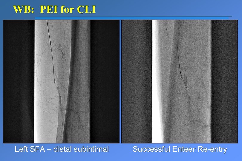 WB: PEI for CLI Left SFA – distal subintimal Successful Enteer Re-entry 