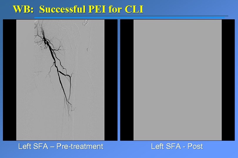 WB: Successful PEI for CLI Left SFA – Pre-treatment Left SFA - Post 