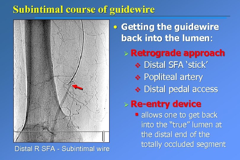 Subintimal course of guidewire • Getting the guidewire back into the lumen: Ø Retrograde