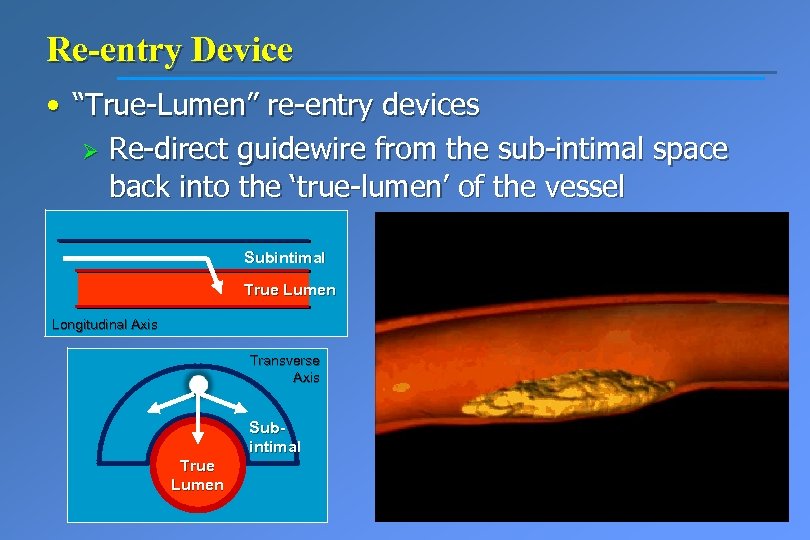 Re-entry Device • “True-Lumen” re-entry devices Ø Re-direct guidewire from the sub-intimal space back