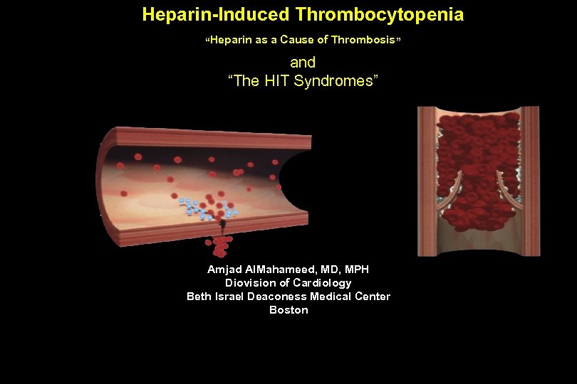 Heparin-Induced Thrombocytopenia “Heparin as a Cause of Thrombosis” and “The HIT Syndromes” Amjad Al.