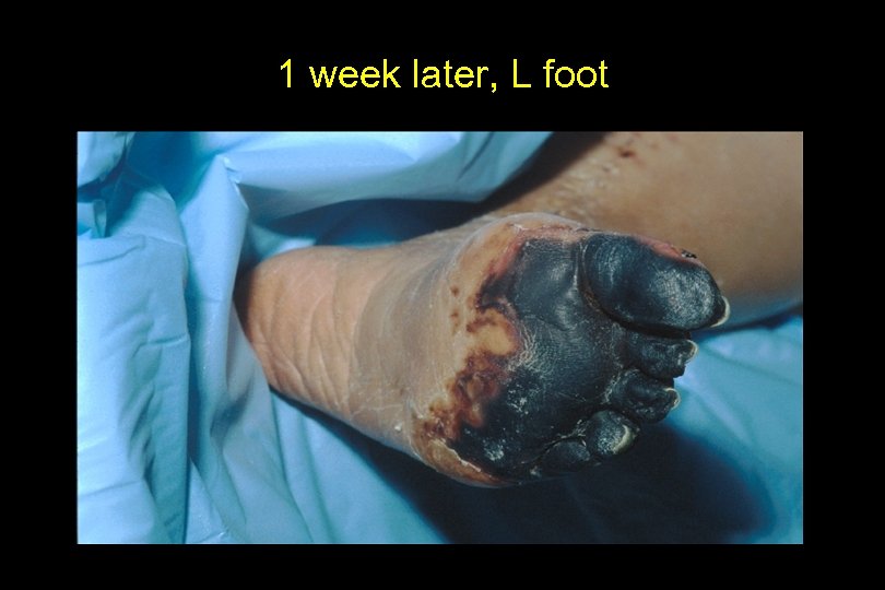 1 week later, L foot 