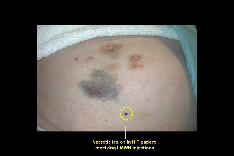 Necrotic lesion in HIT patient receiving LMWH injections 